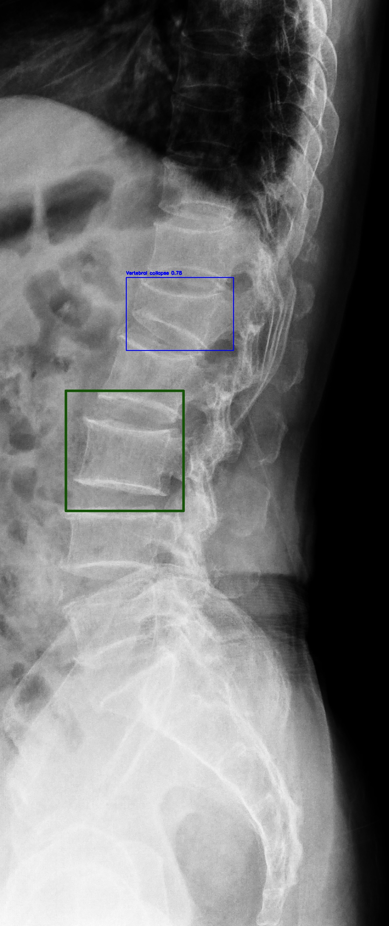 Vertebral Collapse